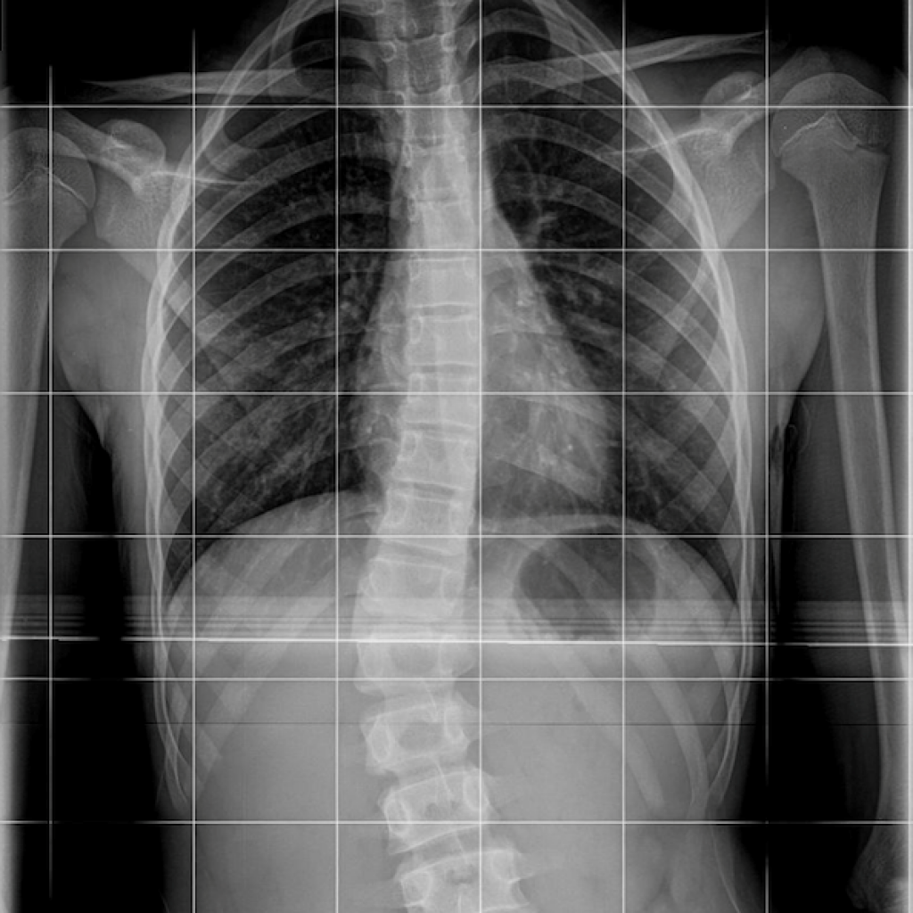 Casella di testo:  Figure 1: Radiografia di una scoliosi idiopatica